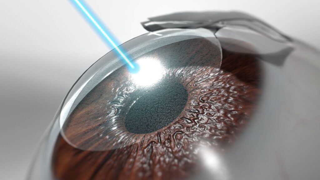 Laser Eye Surgery